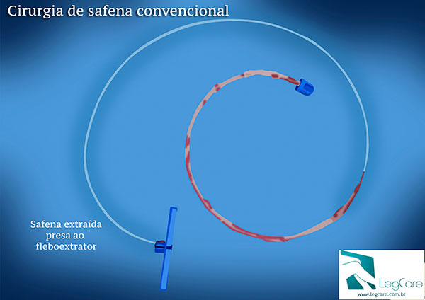 Cirurgia de Safena Convencional