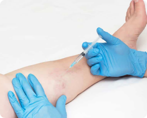 Escleroterapia em São Paulo
