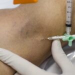 Aplicação de Espuma Em Varizes: Tudo sobre o procedimento