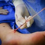 Cirurgia para retirada de safena: quando é necessária