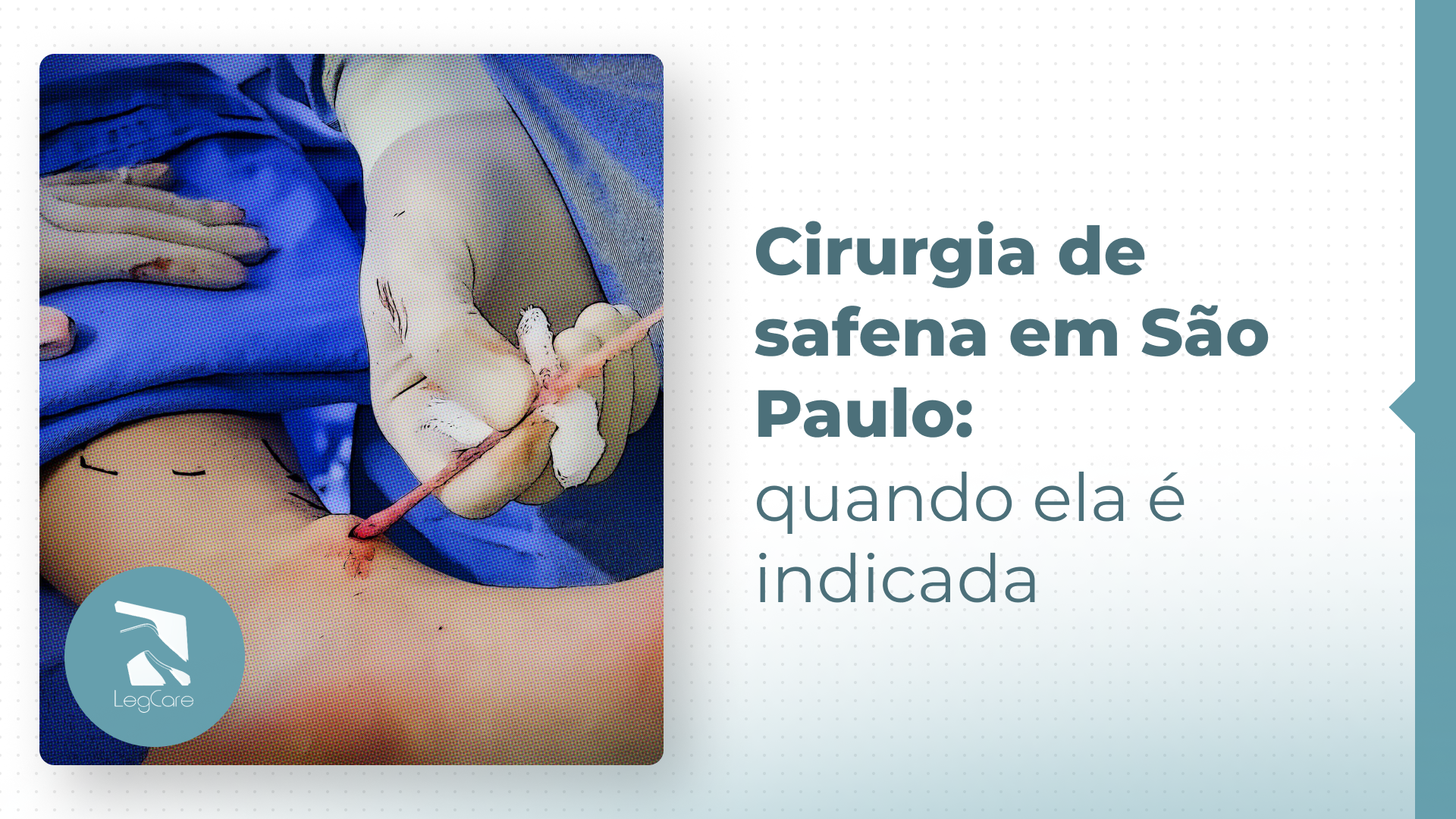 Quando a remoção da veia de safena em São Paulo é indicada e como funciona?