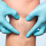 Angiologistas em São Paulo: Saiba onde encontrar