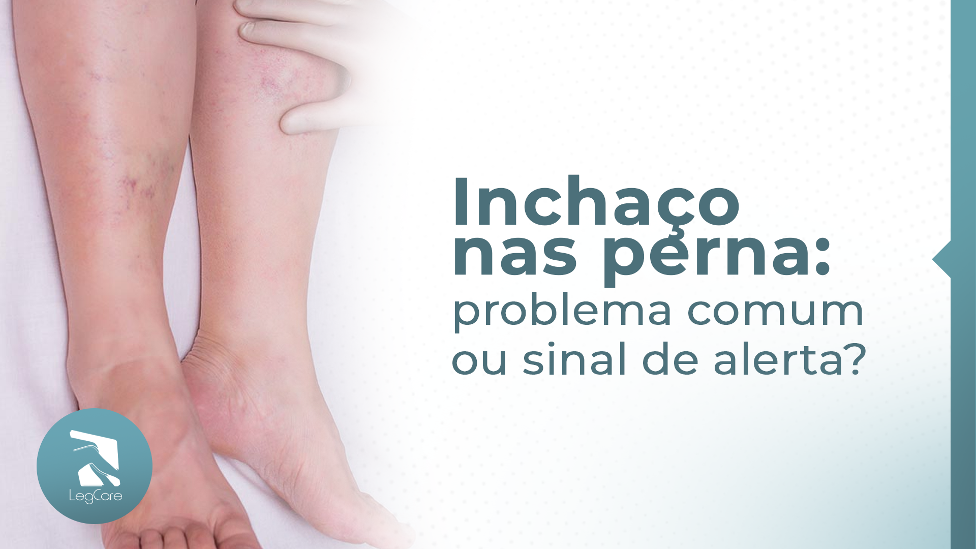 Inchaço nas pernas: problema comum ou sinal de alerta?
