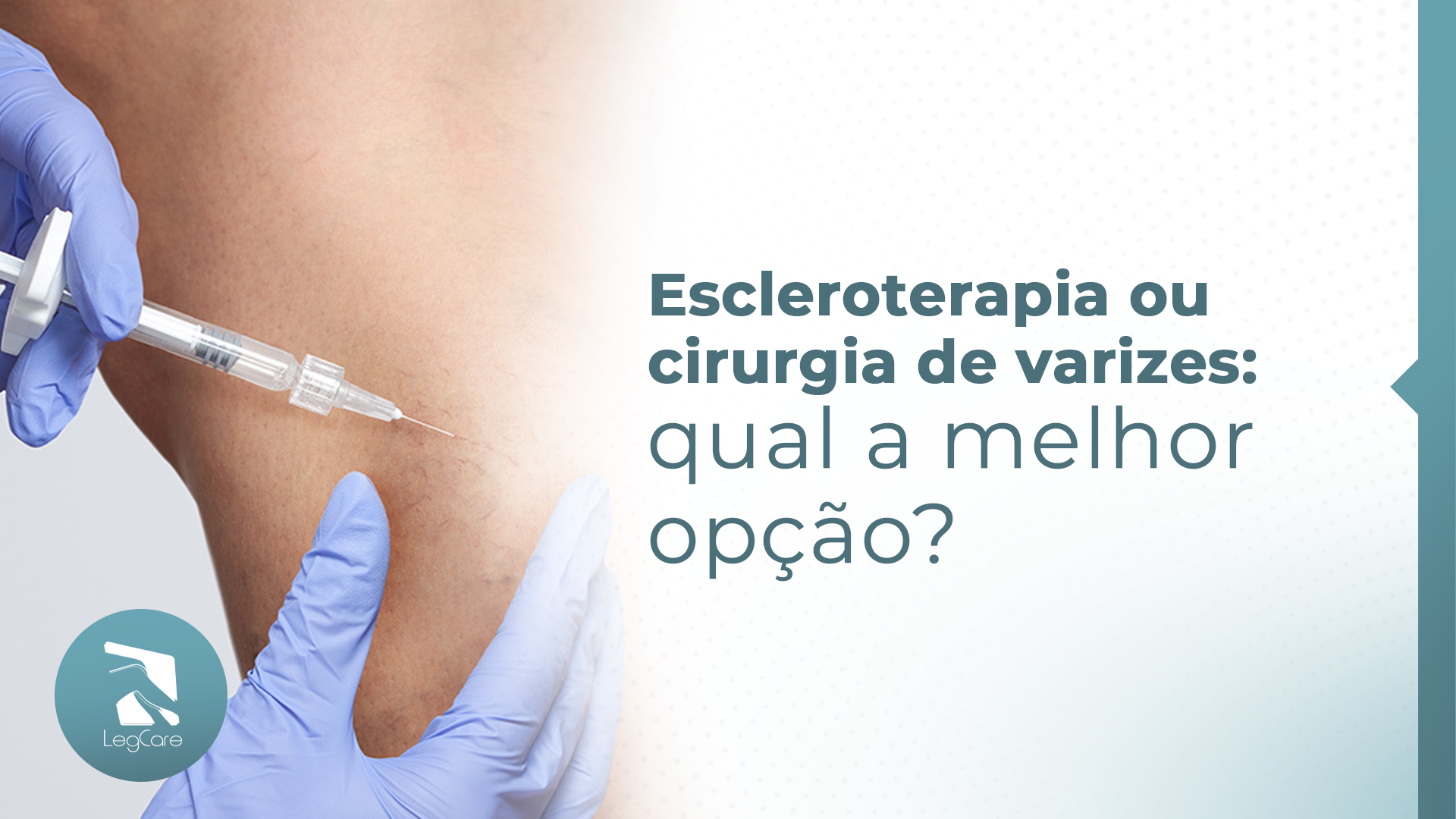 Escleroterapia ou cirurgia de varizes: qual a melhor opção?