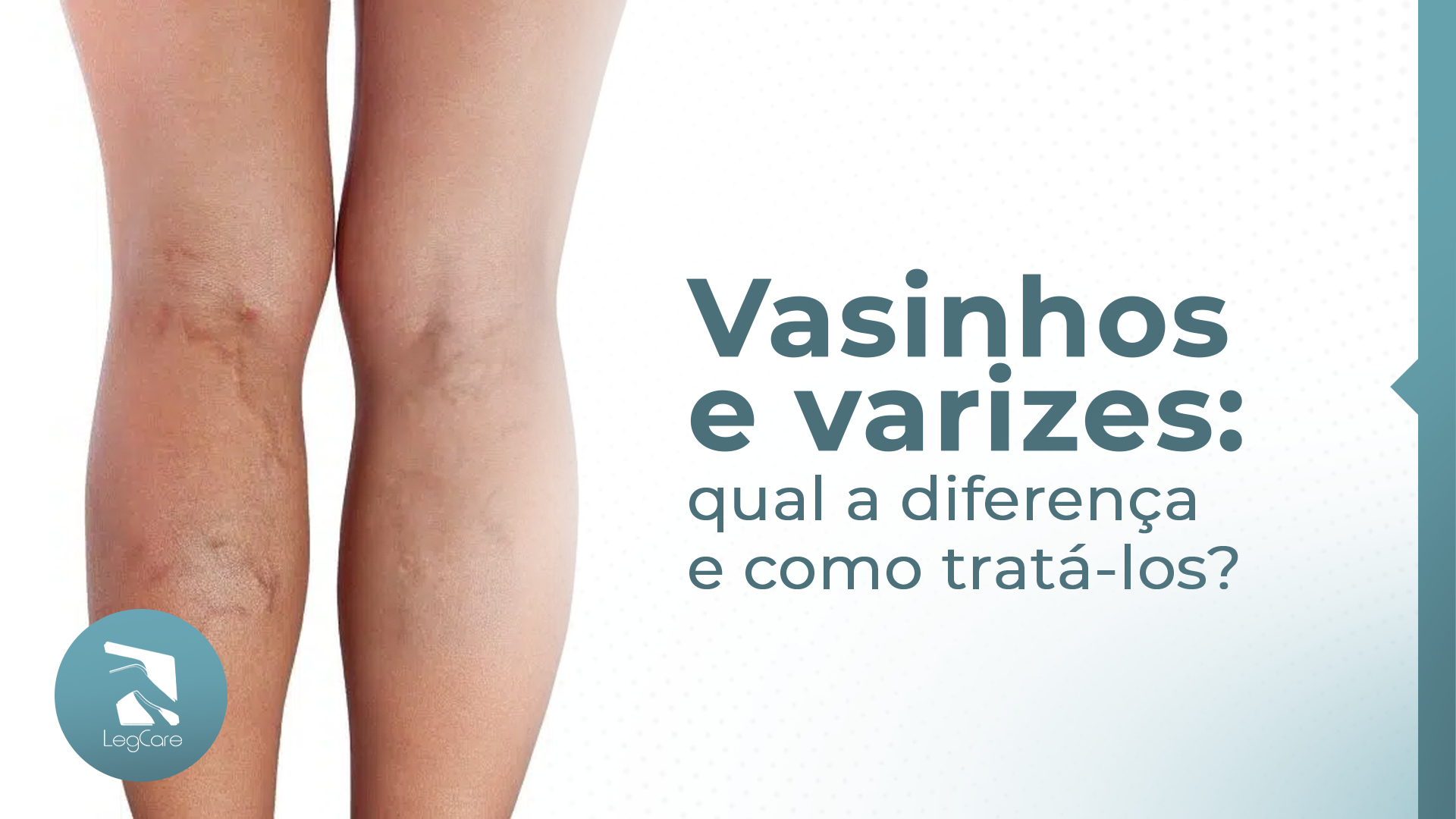  Vasinhos e varizes: qual a diferença e como tratá-los?