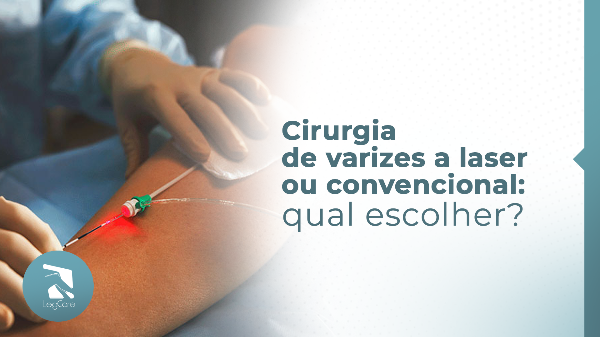 Cirurgia de varizes a laser ou convencional: qual escolher?