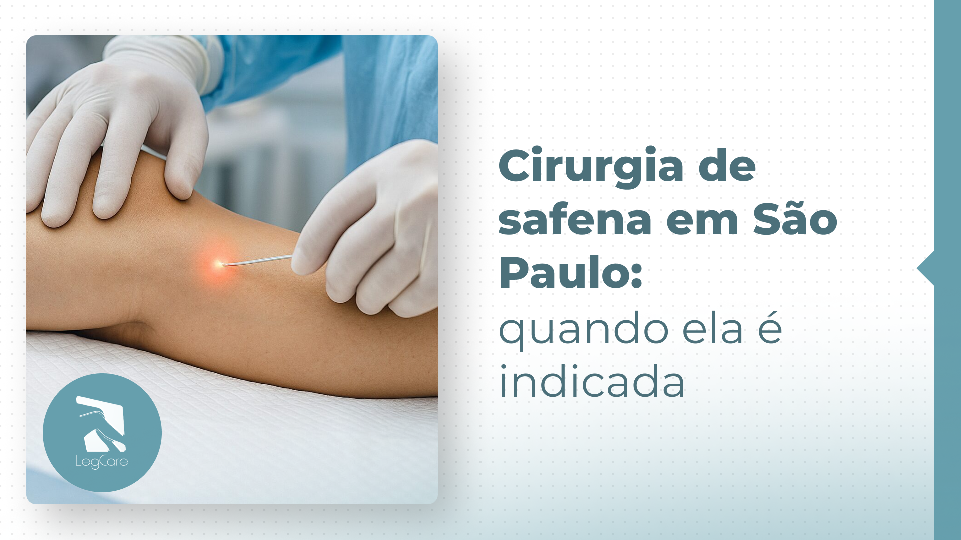Cirurgia de safena em São Paulo: quando ela ainda é necessária?