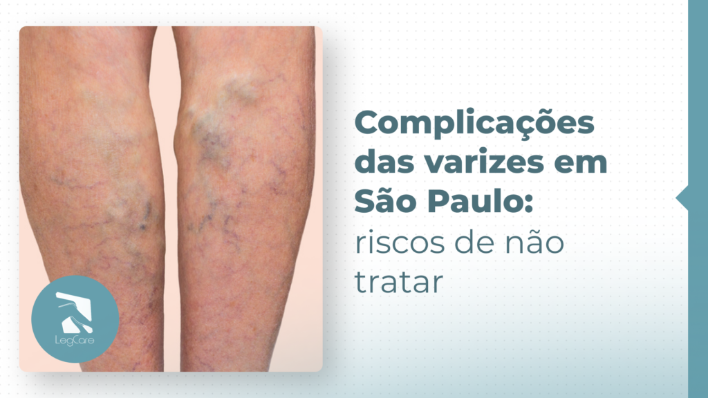 Complicações das varizes em São Paulo: quais são os riscos reais de não tratar corretamente?