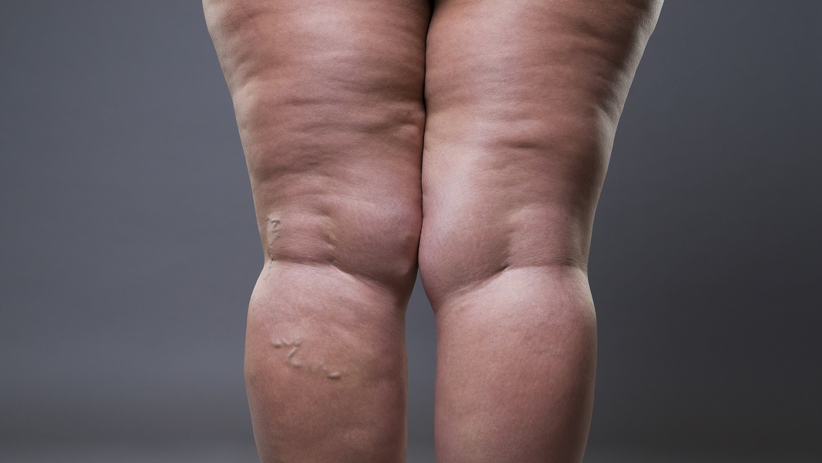 Tratamento para lipedema em São Paulo