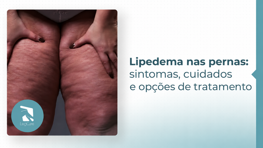 Lipedema nas pernas: sintomas, cuidados e opções de tratamento