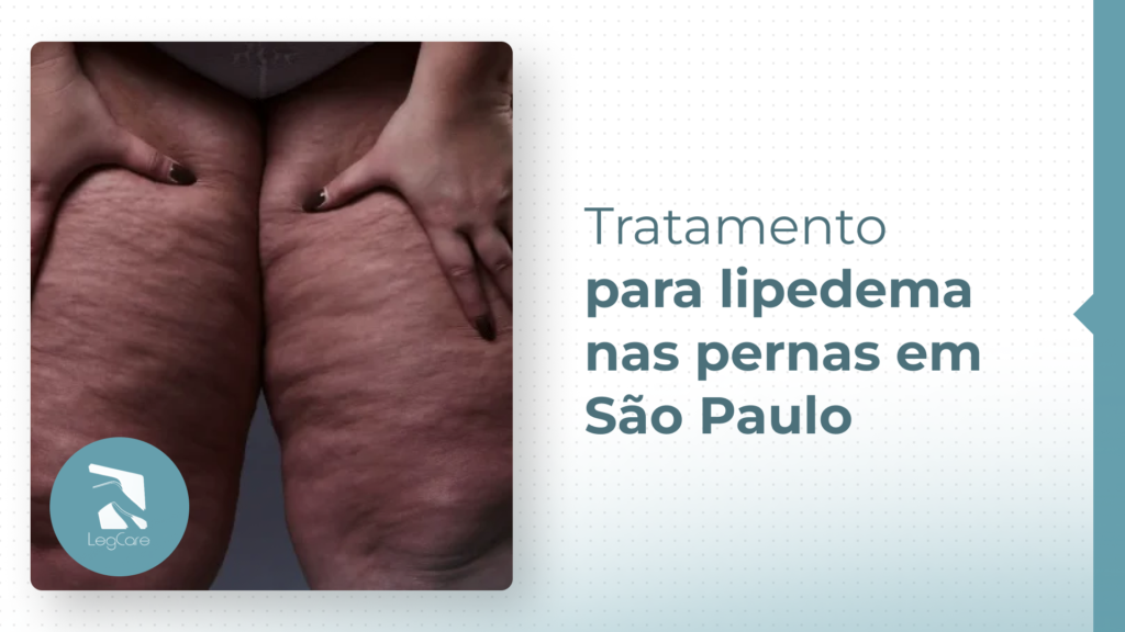 Tratamento para lipedema nas pernas em São Paulo